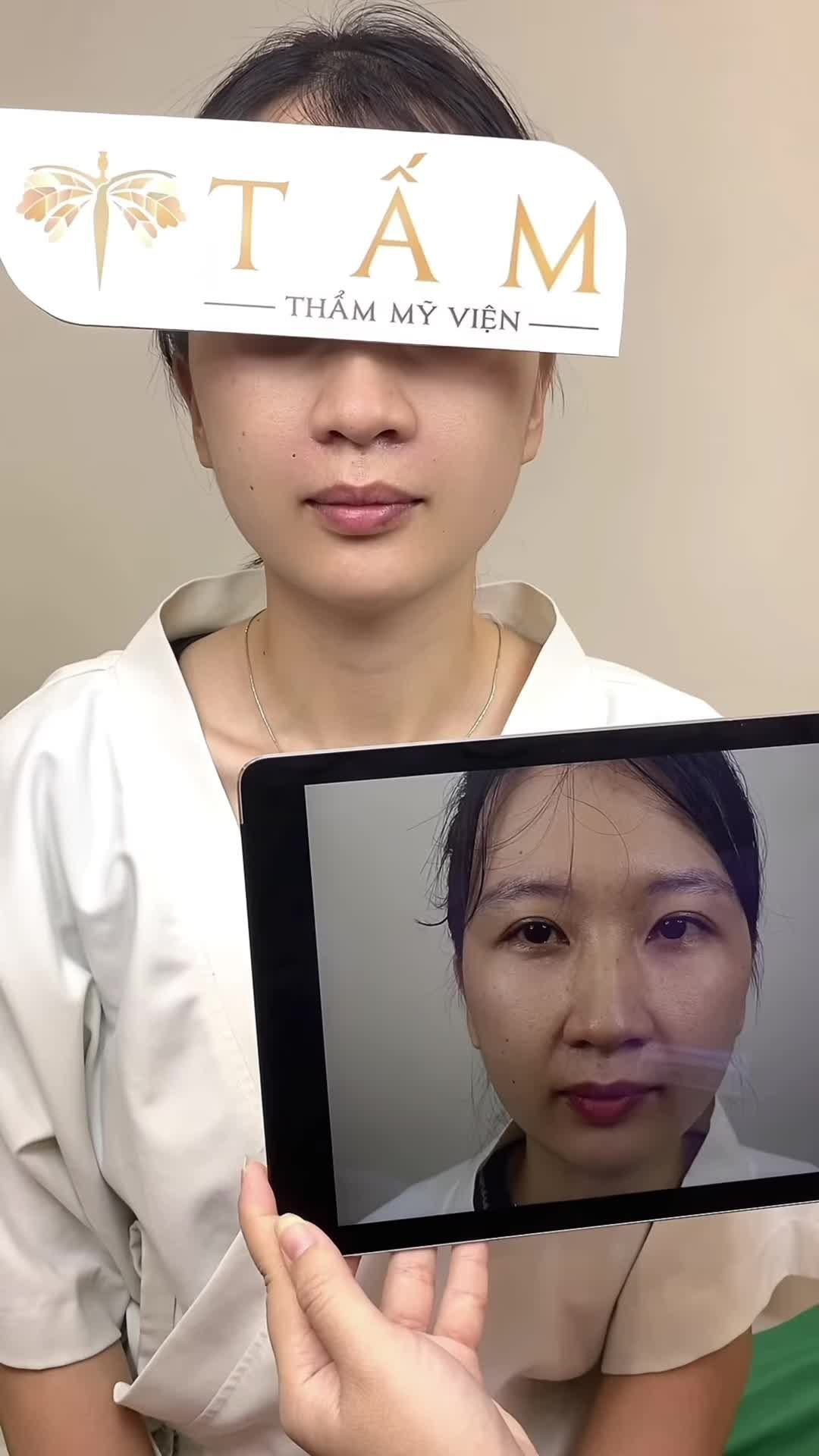 Ca cân chỉnh gương mặt nhờ combo filler tại phòng khám thẩm mỹ viện Tấm.